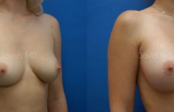 Breast Augmentation Before and After | Sayah Institute