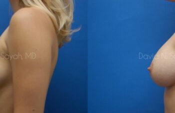 Breast Augmentation Before and After | Sayah Institute