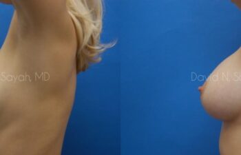 Breast Augmentation Before and After | Sayah Institute