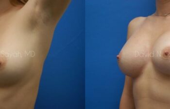 Breast Augmentation Before and After | Sayah Institute