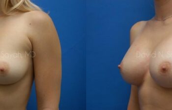 Breast Augmentation Before and After | Sayah Institute