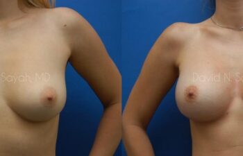 Breast Augmentation Before and After | Sayah Institute