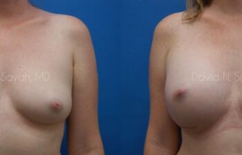 Breast Augmentation Before and After | Sayah Institute