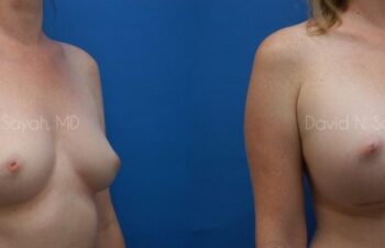 Breast Augmentation Before and After | Sayah Institute