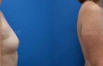 Breast Augmentation Before and After | Sayah Institute