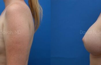 Breast Augmentation Before and After | Sayah Institute