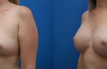 Breast Augmentation Before and After | Sayah Institute