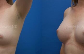 Breast Augmentation Before and After | Sayah Institute
