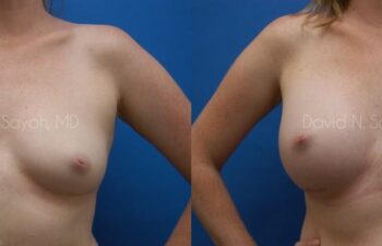 Breast Augmentation Before and After | Sayah Institute