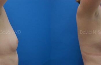 Breast Augmentation Before and After | Sayah Institute