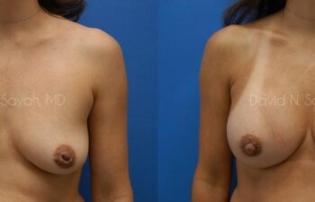 Breast Augmentation Before and After | Sayah Institute