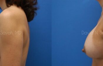 Breast Augmentation Before and After | Sayah Institute