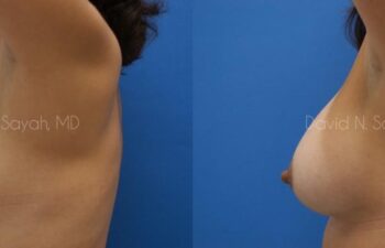 Breast Augmentation Before and After | Sayah Institute