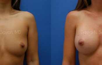 Breast Augmentation Before and After | Sayah Institute