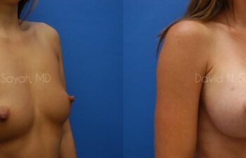 Breast Augmentation Before and After | Sayah Institute