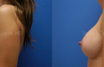 Breast Augmentation Before and After | Sayah Institute