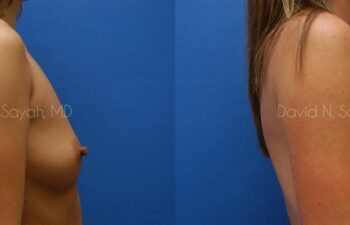 Breast Augmentation Before and After | Sayah Institute