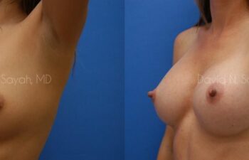 Breast Augmentation Before and After | Sayah Institute