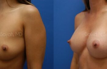 Breast Augmentation Before and After | Sayah Institute