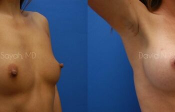Breast Augmentation Before and After | Sayah Institute