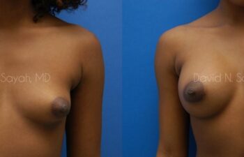 Breast Augmentation Before and After | Sayah Institute