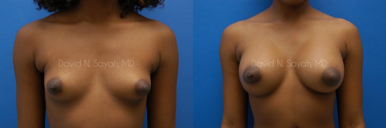 Breast Augmentation Before and After | Sayah Institute