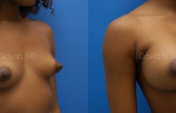 Breast Augmentation Before and After | Sayah Institute