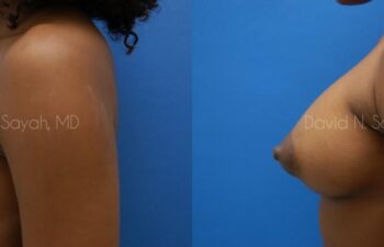 Breast Augmentation Before and After | Sayah Institute