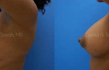 Breast Augmentation Before and After | Sayah Institute