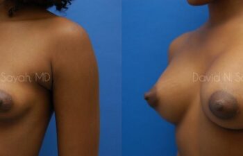 Breast Augmentation Before and After | Sayah Institute