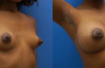 Breast Augmentation Before and After | Sayah Institute