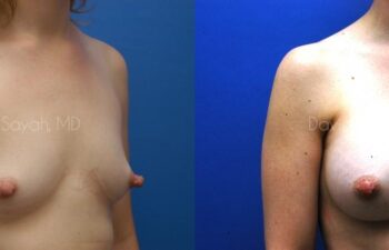 Breast Augmentation Before and After | Sayah Institute