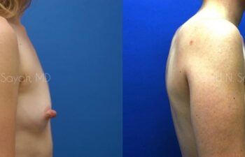 Breast Augmentation Before and After | Sayah Institute