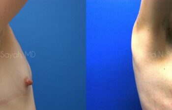 Breast Augmentation Before and After | Sayah Institute