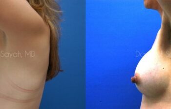 Breast Augmentation Before and After | Sayah Institute