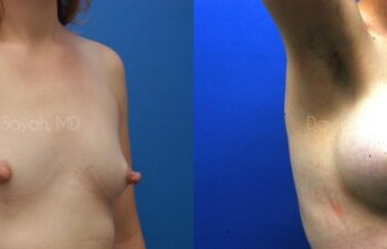 Breast Augmentation Before and After | Sayah Institute