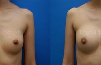 Breast Augmentation Before and After | Sayah Institute