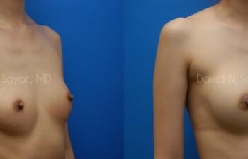 Breast Augmentation Before and After | Sayah Institute