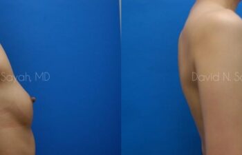 Breast Augmentation Before and After | Sayah Institute