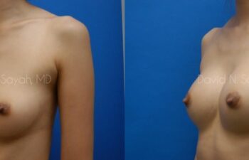 Breast Augmentation Before and After | Sayah Institute