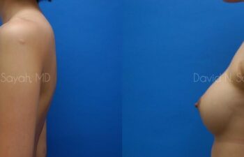 Breast Augmentation Before and After | Sayah Institute