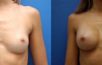 Breast Augmentation Before and After | Sayah Institute