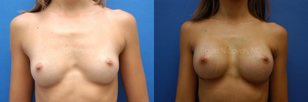 Breast Augmentation Before and After | Sayah Institute