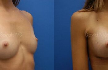 Breast Augmentation Before and After | Sayah Institute