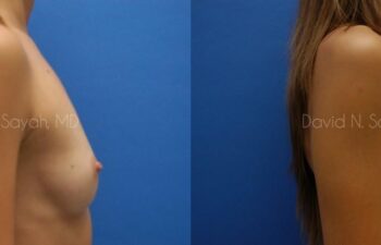 Breast Augmentation Before and After | Sayah Institute