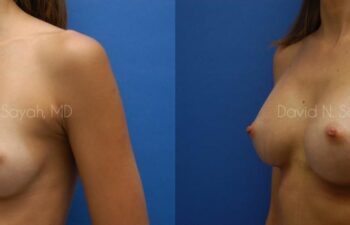 Breast Augmentation Before and After | Sayah Institute