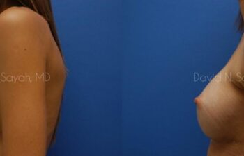 Breast Augmentation Before and After | Sayah Institute