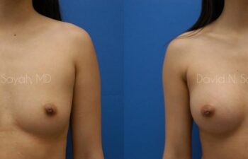 Breast Augmentation Before and After | Sayah Institute