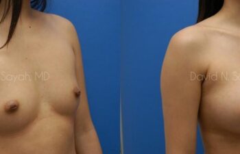 Breast Augmentation Before and After | Sayah Institute