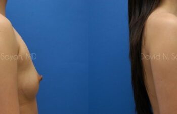 Breast Augmentation Before and After | Sayah Institute